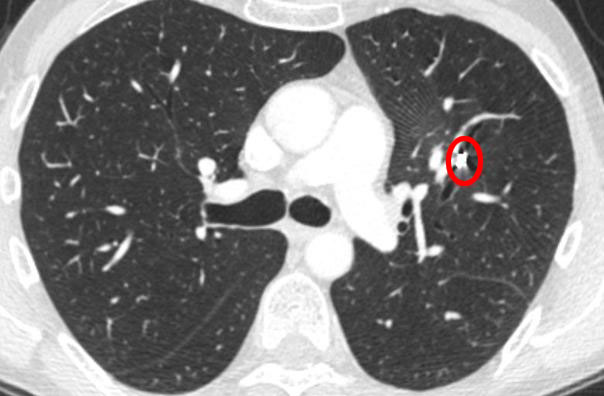 How To Interpret CT Scans Of Your Lung How To Interpret CT Scans Of Your Lung
