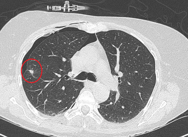 How to interpret CT scans of your lung