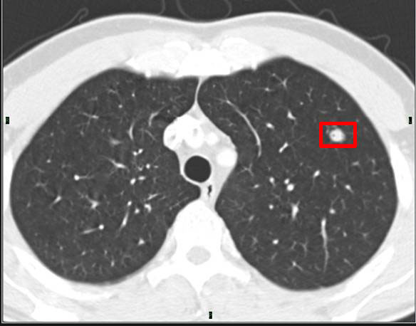 How to interpret CT scans of lung