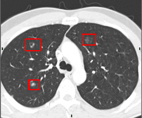 how does doctor diagnose copd