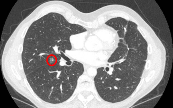 How To Interpret Ct Scans Of Your Lung