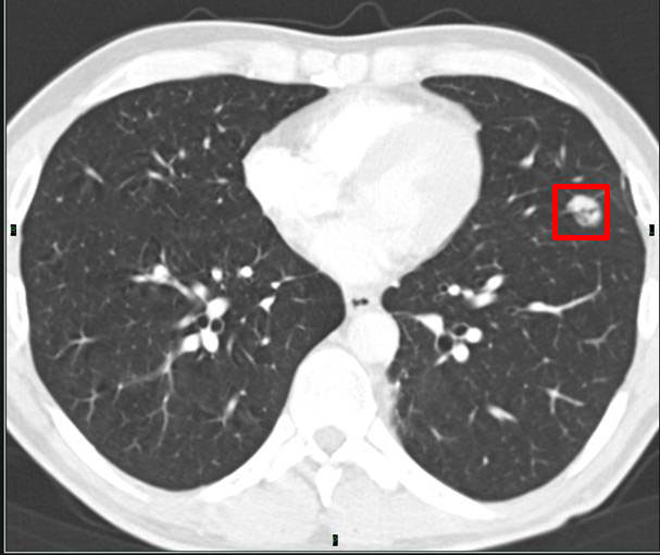 How to interpret CT scans of lung