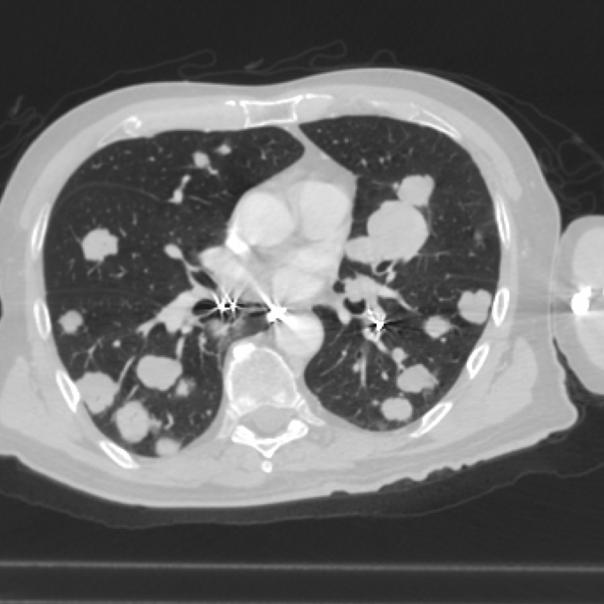 The following two pictures show a CT scan of the lungs with and without con...